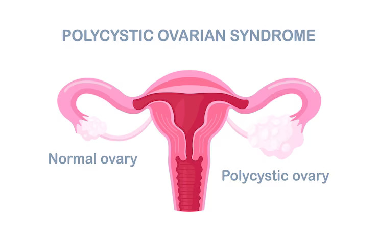 Lifestyle Modifications and Management of PCOS